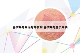 喜樹(shù)果外用治療牛皮癬 喜樹(shù)果是什么中藥