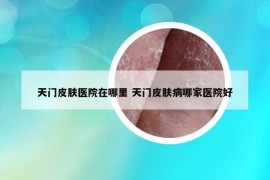 天門皮膚醫(yī)院在哪里 天門皮膚病哪家醫(yī)院好