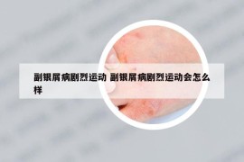 副銀屑病劇烈運(yùn)動 副銀屑病劇烈運(yùn)動會怎么樣