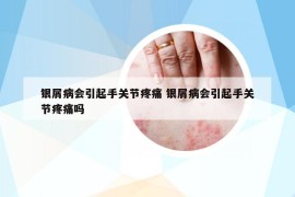 銀屑病會(huì)引起手關(guān)節(jié)疼痛 銀屑病會(huì)引起手關(guān)節(jié)疼痛嗎