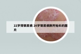 22歲得銀屑病 20歲銀屑病剛開始長的圖片