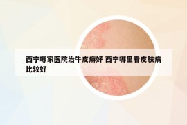 西寧哪家醫(yī)院治牛皮癬好 西寧哪里看皮膚病比較好