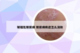 皺褶處銀屑病 銀屑病痕跡怎么消除