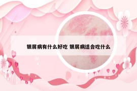 銀屑病有什么好吃 銀屑病適合吃什么