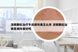 消銀顆粒治療牛皮癬效果怎么樣 消銀顆粒治銀屑病效果好嗎