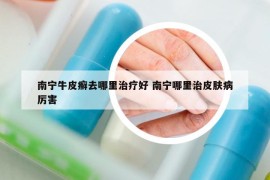 南寧牛皮癬去哪里治療好 南寧哪里治皮膚病厲害