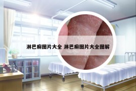 淋巴癬圖片大全 淋巴癬圖片大全圖解