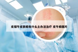 皮褶牛皮膚癬有什么土辦法治療 皮牛癬圖片