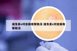 維生素e對(duì)皮癬有幫助沒(méi) 維生素e對(duì)皮癬有幫助沒(méi)
