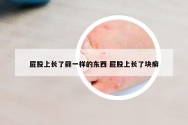 屁股上長(zhǎng)了蘚一樣的東西 屁股上長(zhǎng)了塊癬
