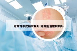 雄黃對(duì)牛皮癬有用嗎 雄黃能治銀屑病嗎