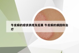 牛皮癬的癥狀表現(xiàn)及后果 牛皮癬的病因和治療