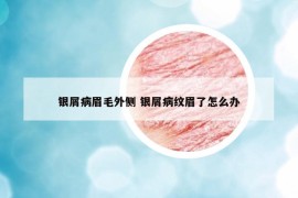 銀屑病眉毛外側(cè) 銀屑病紋眉了怎么辦