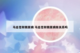 馬齒莧和銀屑病 馬齒莧和銀屑病有關(guān)系嗎