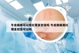 牛皮癬癢可以擦紅霉素軟膏嗎 牛皮膚癬用紅霉素軟膏可以嗎