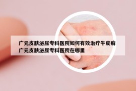 廣元皮膚泌尿?qū)？漆t(yī)院如何有效治療牛皮癬 廣元皮膚泌尿?qū)？漆t(yī)院在哪里