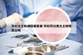 孕婦凡士林減輕銀屑病 孕婦可以用凡士林擦傷口嗎