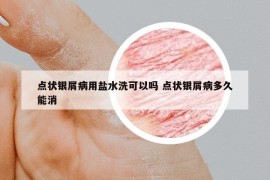 點狀銀屑病用鹽水洗可以嗎 點狀銀屑病多久能消