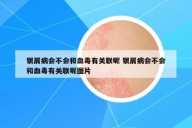 銀屑病會不會和血毒有關(guān)聯(lián)呢 銀屑病會不會和血毒有關(guān)聯(lián)呢圖片
