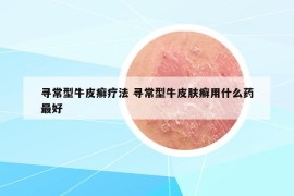 尋常型牛皮癬療法 尋常型牛皮膚癬用什么藥最好