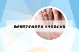 治療銀屑的的幾種藥膏 治療銀屑的軟膏