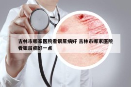吉林市哪家醫(yī)院看銀屑病好 吉林市哪家醫(yī)院看銀屑病好一點