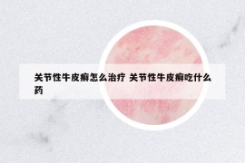 關(guān)節(jié)性牛皮癬怎么治療 關(guān)節(jié)性牛皮癬吃什么藥
