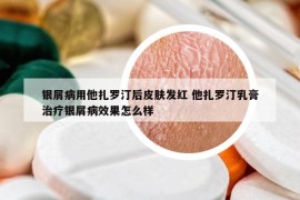 銀屑病用他扎羅汀后皮膚發(fā)紅 他扎羅汀乳膏治療銀屑病效果怎么樣