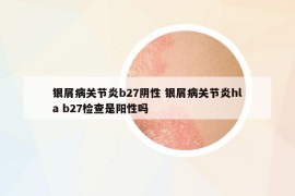 銀屑病關(guān)節(jié)炎b27陰性 銀屑病關(guān)節(jié)炎hla b27檢查是陽性嗎
