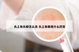 頭上有頭癬怎么洗 頭上有癬用什么藥膏