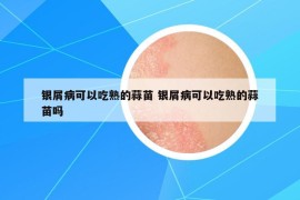 銀屑病可以吃熟的蒜苗 銀屑病可以吃熟的蒜苗嗎