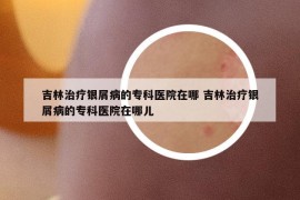 吉林治療銀屑病的?？漆t(yī)院在哪 吉林治療銀屑病的?？漆t(yī)院在哪兒