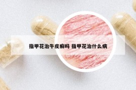 指甲花治牛皮癬嗎 指甲花治什么病