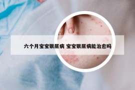 六個(gè)月寶寶銀屑病 寶寶銀屑病能治愈嗎