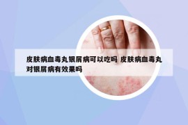 皮膚病血毒丸銀屑病可以吃嗎 皮膚病血毒丸對(duì)銀屑病有效果嗎