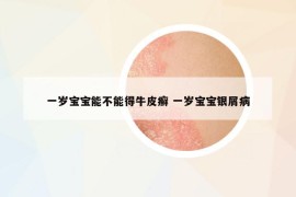 一歲寶寶能不能得牛皮癬 一歲寶寶銀屑病