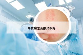 牛皮癬怎么都只不好