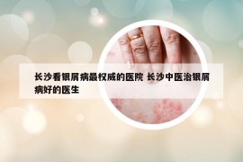 長沙看銀屑病最權(quán)威的醫(yī)院 長沙中醫(yī)治銀屑病好的醫(yī)生