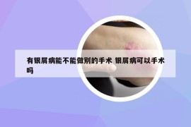 有銀屑病能不能做別的手術 銀屑病可以手術嗎