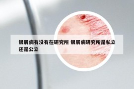 銀屑病有沒(méi)有在研究所 銀屑病研究所是私立還是公立