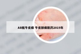AB瓶牛皮癬 牛皮膚癬新藥2019年