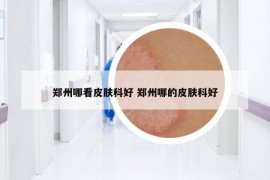 鄭州哪看皮膚科好 鄭州哪的皮膚科好