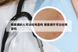 銀屑病的人可以吃雞蛋嗎 銀屑病不可以吃雞蛋嗎