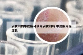 潤膚劑的牛皮癬可以用潤膚劑嗎 牛皮癬用保濕乳