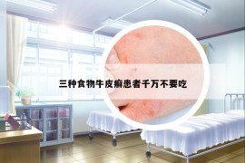 三種食物牛皮癬患者千萬不要吃