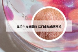 江門牛皮癬醫(yī)院 江門皮膚病醫(yī)院嗎