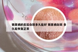 銀屑病的愈后白斑多久能好 銀屑病白斑 多久能恢復(fù)正常