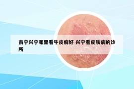 南寧興寧哪里看牛皮癬好 興寧看皮膚病的診所