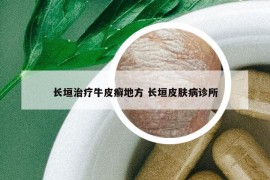 長垣治療牛皮癬地方 長垣皮膚病診所