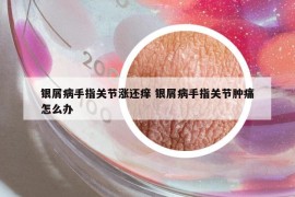銀屑病手指關(guān)節(jié)漲還癢 銀屑病手指關(guān)節(jié)腫痛怎么辦